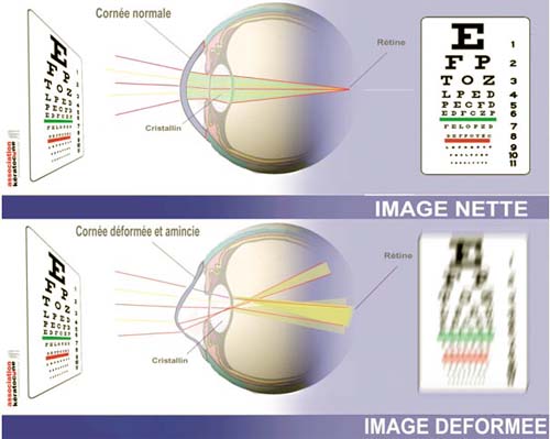 oeil_defor​mation